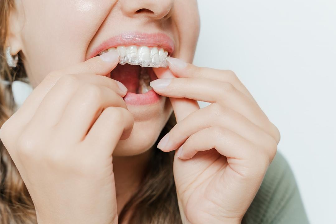 Aligner vs Retainer